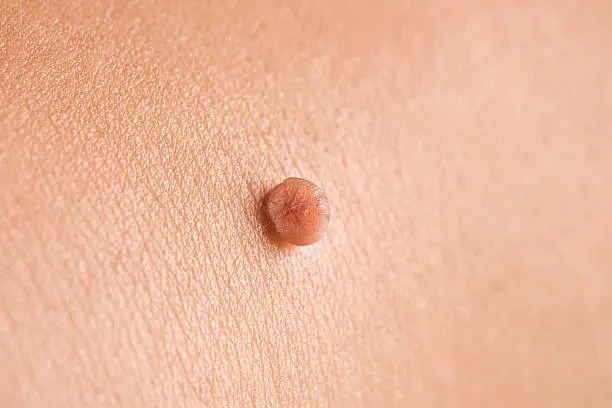 쥐젖/편평사마귀