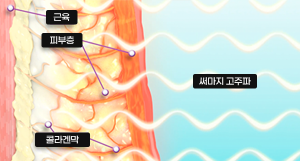 써마지 고주파